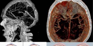 Что можно обнаружить на КТ головного мозга?