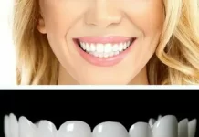 Виниры-показания и противопоказания, способы установки