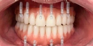 Имплантация зубов: откройте новые возможности для улыбки