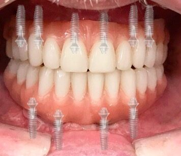 Имплантация зубов: откройте новые возможности для улыбки